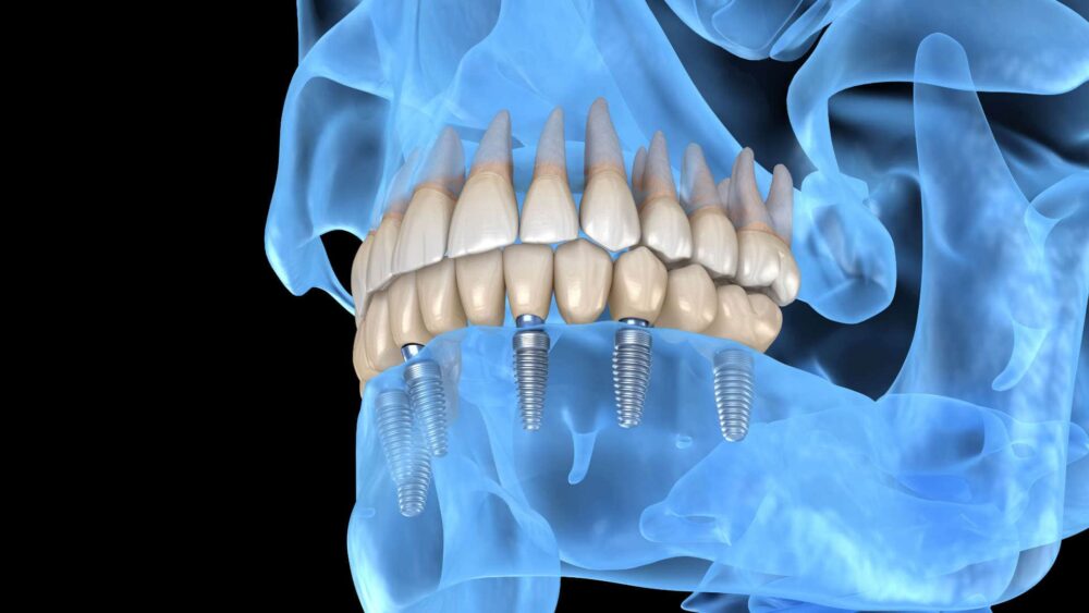 Τα οδοντικά εμφυτεύματα All-on-4 αισθάνονται σαν πραγματικά δόντια;