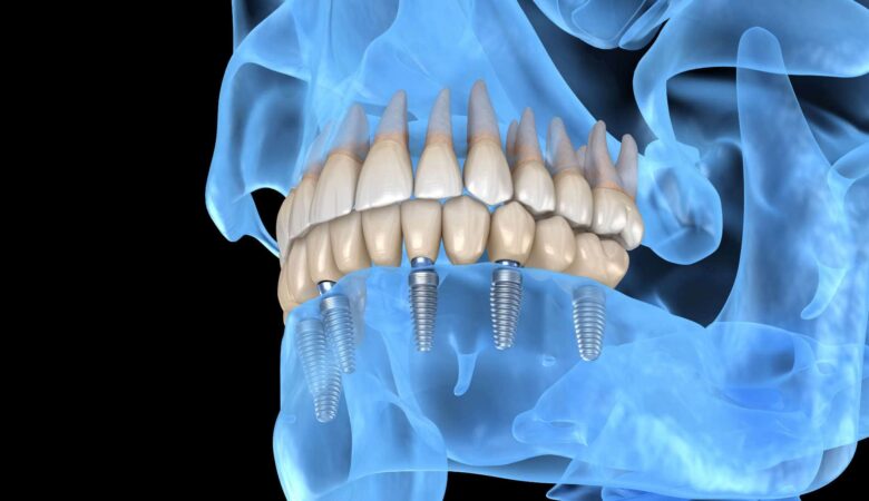 Τα οδοντικά εμφυτεύματα All-on-4 αισθάνονται σαν πραγματικά δόντια;
